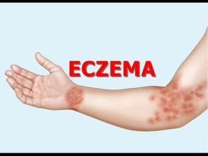 eczema flare up locations