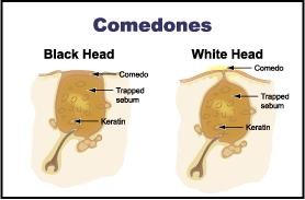 what are comedons