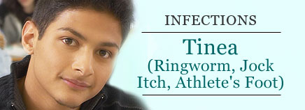 tinea-infections-include-jock-itch