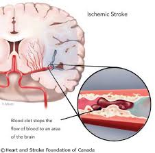 Obat Stroke Iskemik Herbal