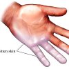 Frostbite or Frostnip – Do you Know the Difference?