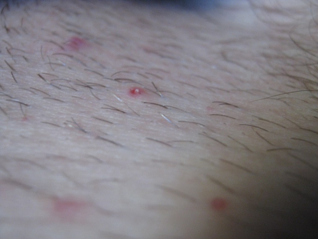 Сыпь на лобке и зуд Вопрос дерматологу 03 Онлайн