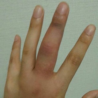 手骨折種類 骨折の種類と要する期間 疲労骨折 骨端板 骨軟骨癥 Xhymp