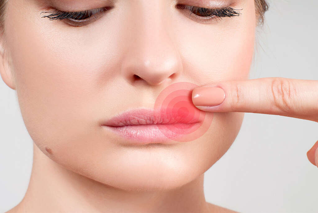 Fever Blister Fever Blisters Causes and Remedies