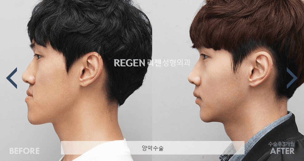 Double Jaw Surgery in Korea Regen Plastic Surgery 10