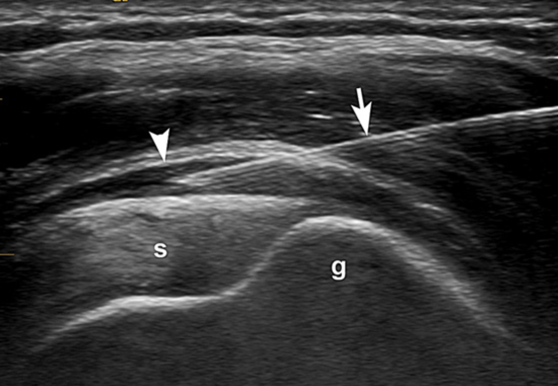 UltrasoundGuided Injection of the SubacromialSubdeltoi 123 Sonography
