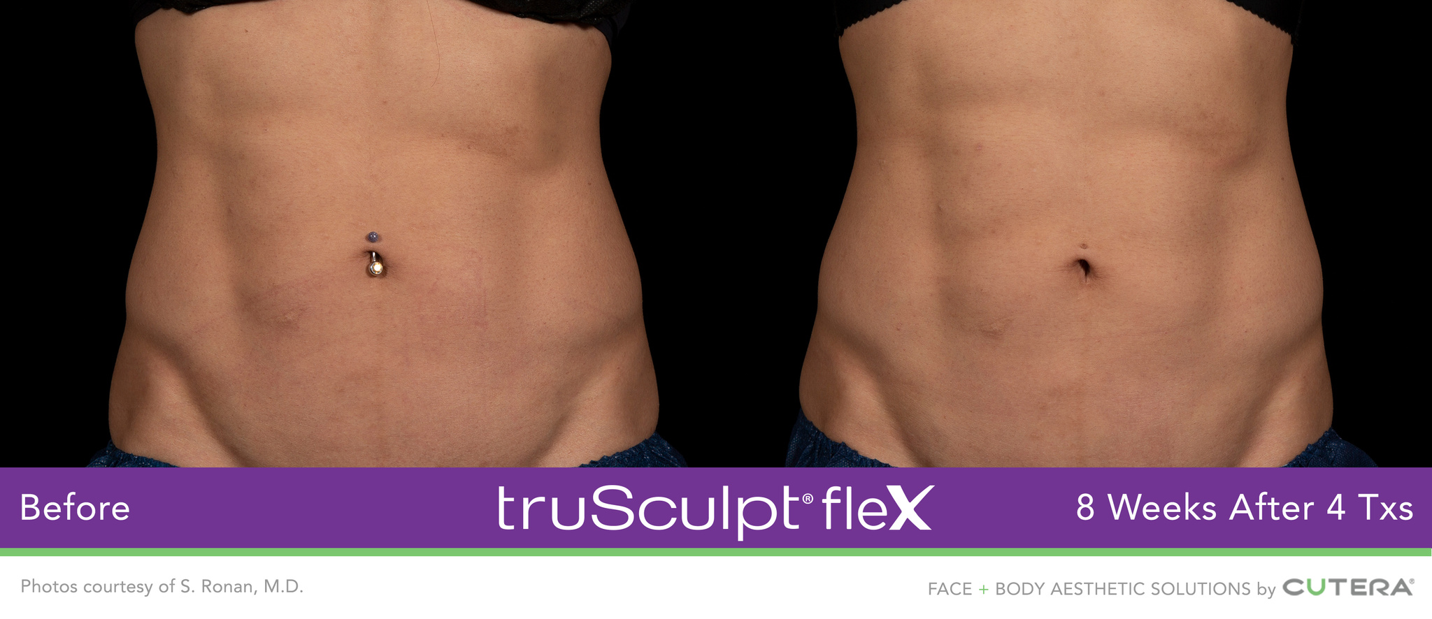 Body Muscle Sculpting Treatment in San Francisco truSculpt fleX