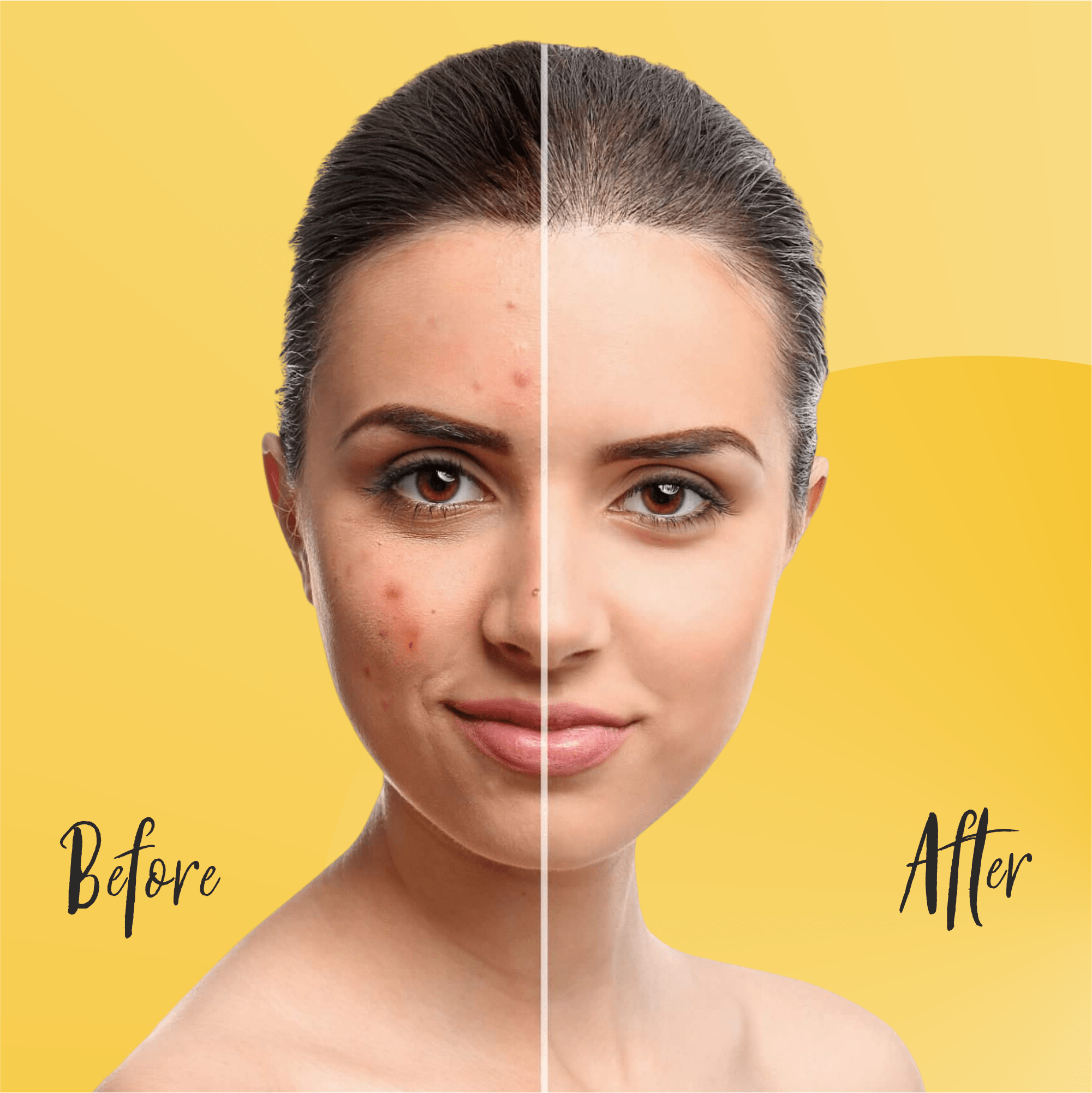 Light Therapy Treatment For Acne Best Device For Skin