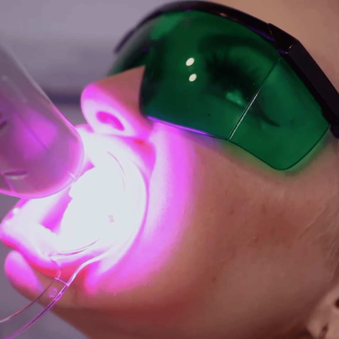 What is Laser Teeth Whitening? We Whiten Aurora, Colorado