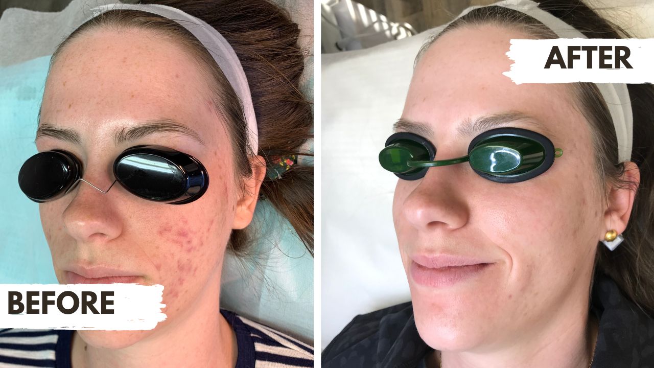 Microneedling Colorado Springs Face Five