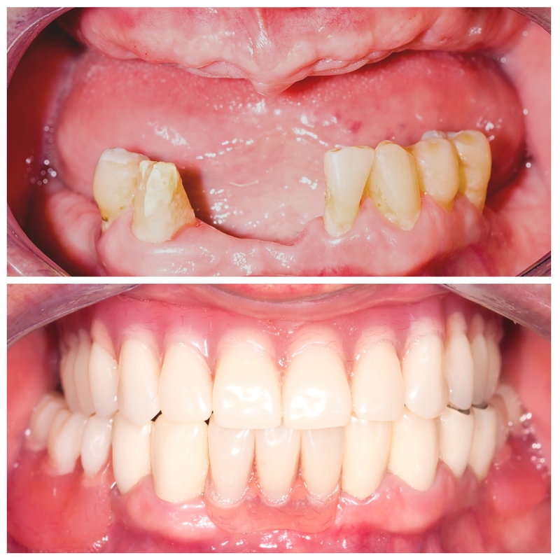 Partial Denture Before And After