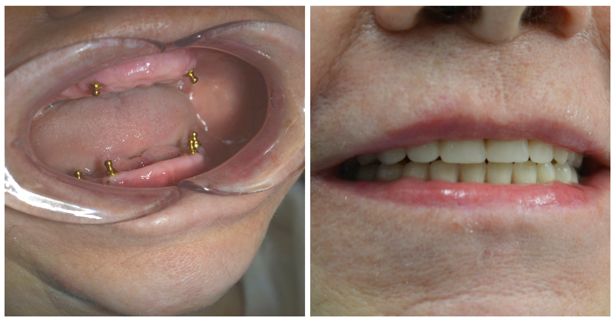 Dental Implants NYC Information & Cost 172 NYC Dental
