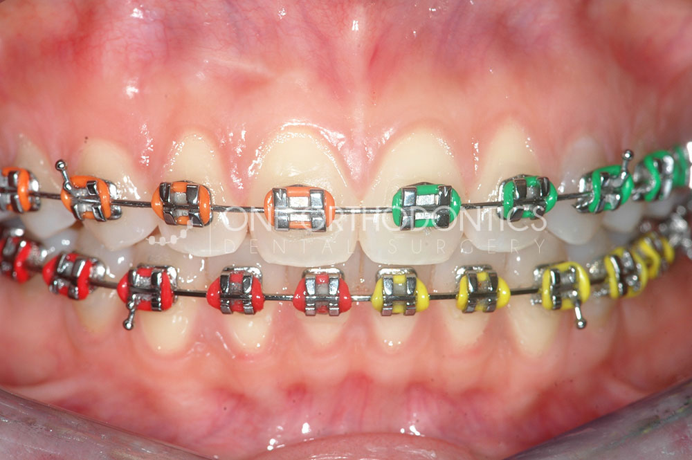 Braces Colours One Orthodontics Dental Surgery