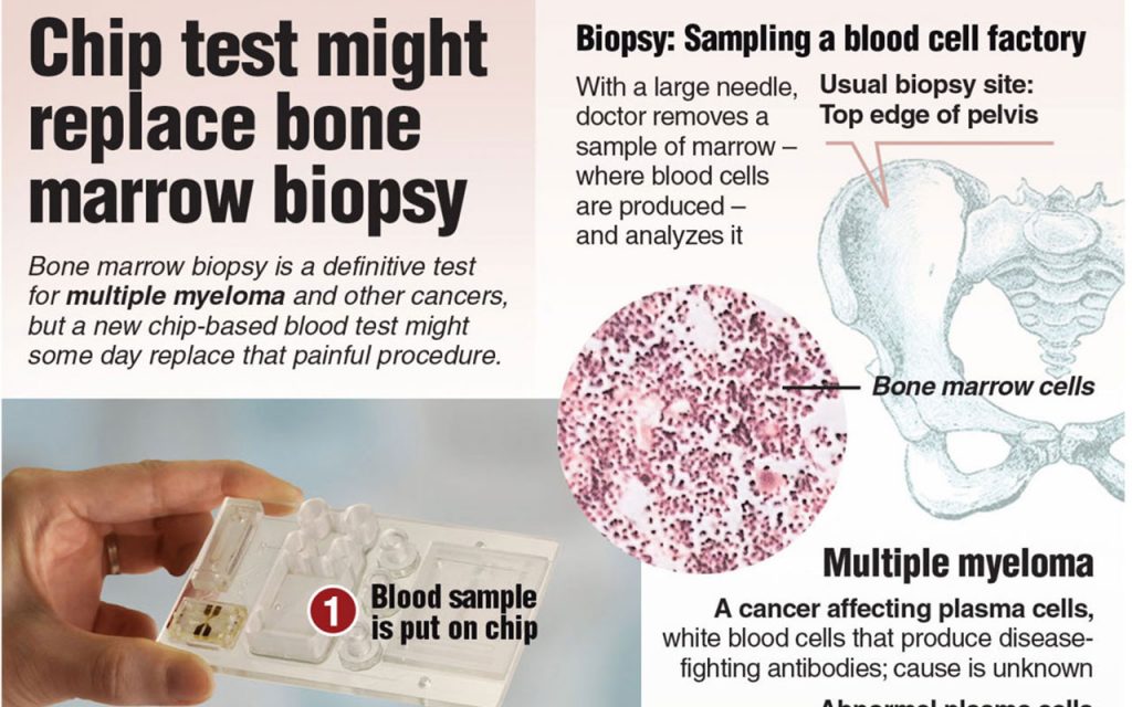 Did You Know? Chip test might replace bone marrow biopsy
