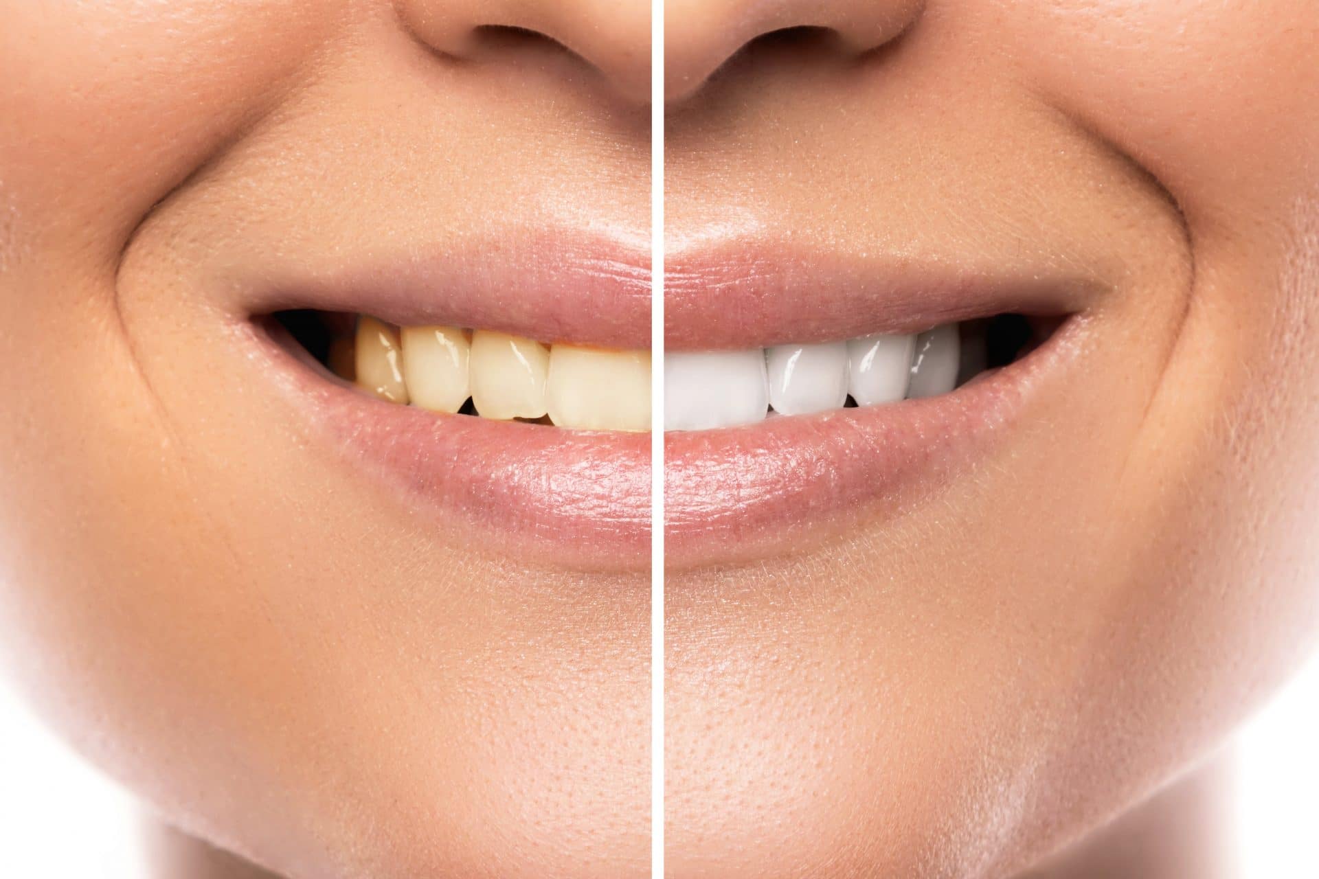 Quiz How Does Teeth Whitening Work? Lafayette, LA