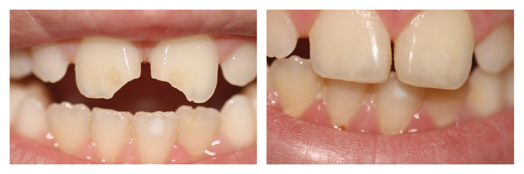 Chipped tooth 24 Hour Emergency Dentist Dublin Emergency Dentist