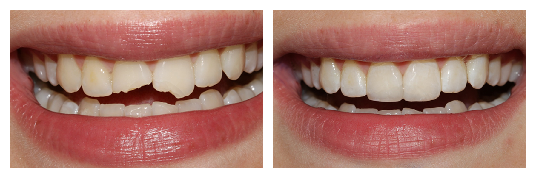 Chipped tooth 24 Hour Emergency Dentist Dublin Emergency Dentist