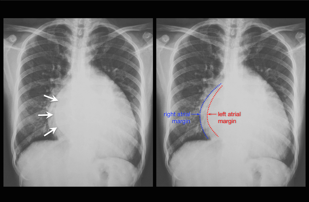 Симптом идущего человека — 24Radiology.ru