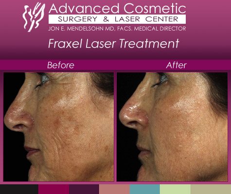 Fraxel Laser Treatment | Gallery