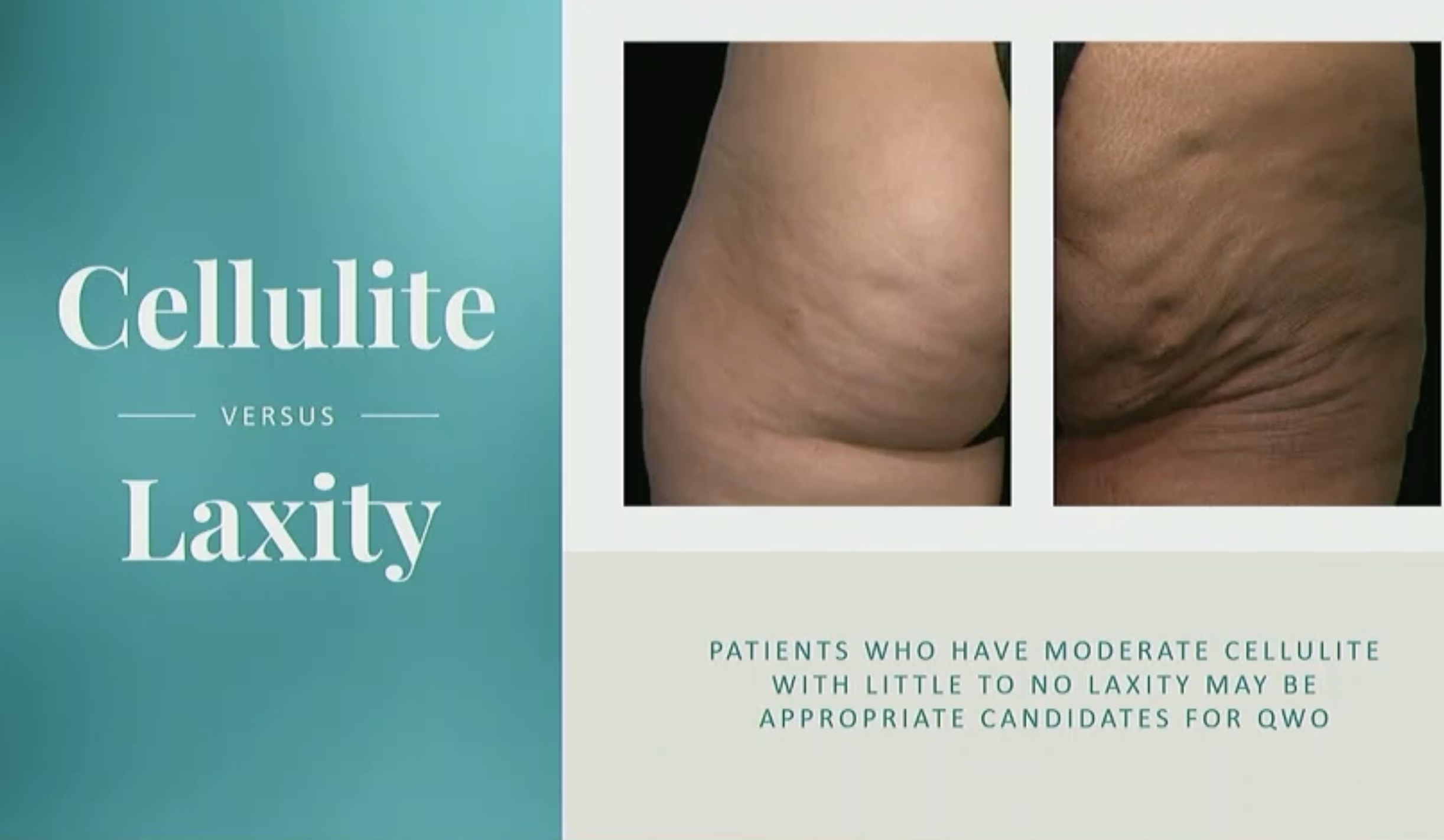 QWO Cellulite Treatment Injection, No Downtime QWO Cincinnati
