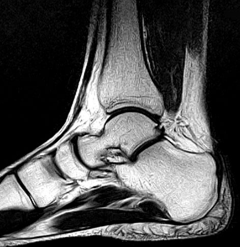 Mri Ankle Effusion : MRI of the ankle (an approach) – YUND