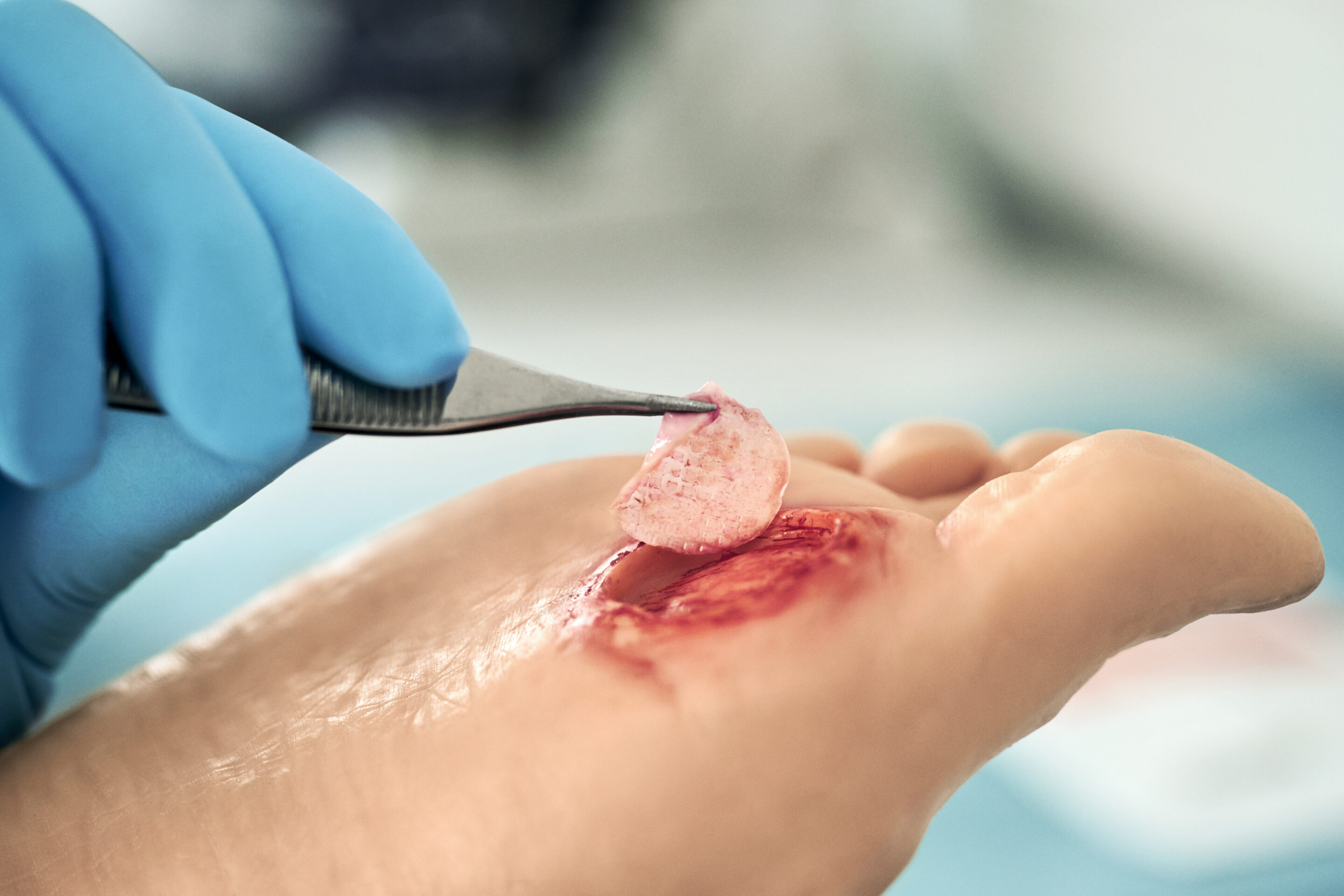 Wound bed preparation and offloading 3C Patch wound