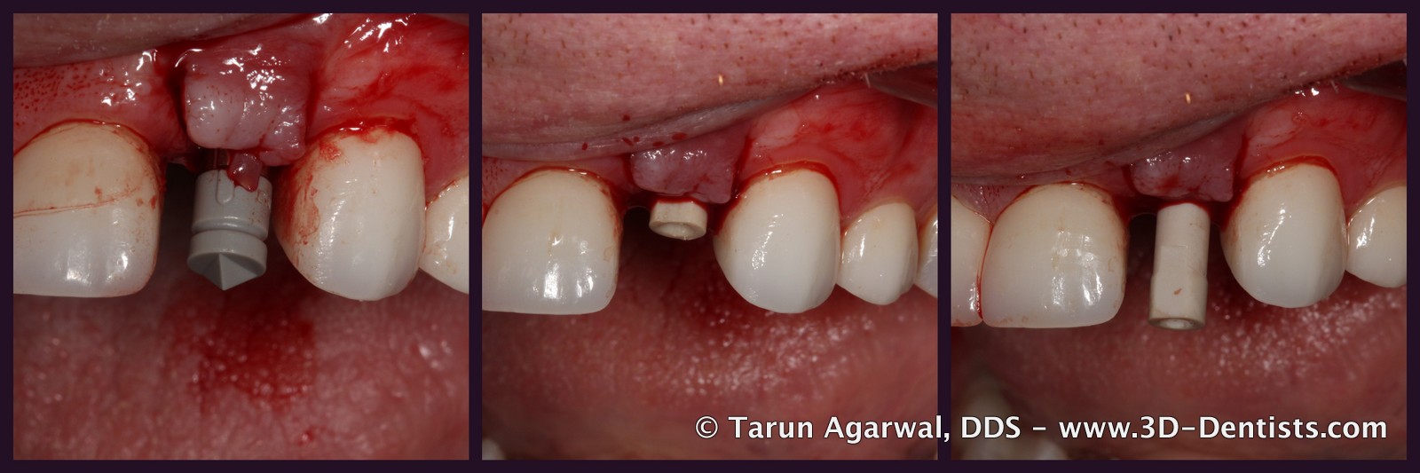Your Digital Implant Impression Options 3D Dentists