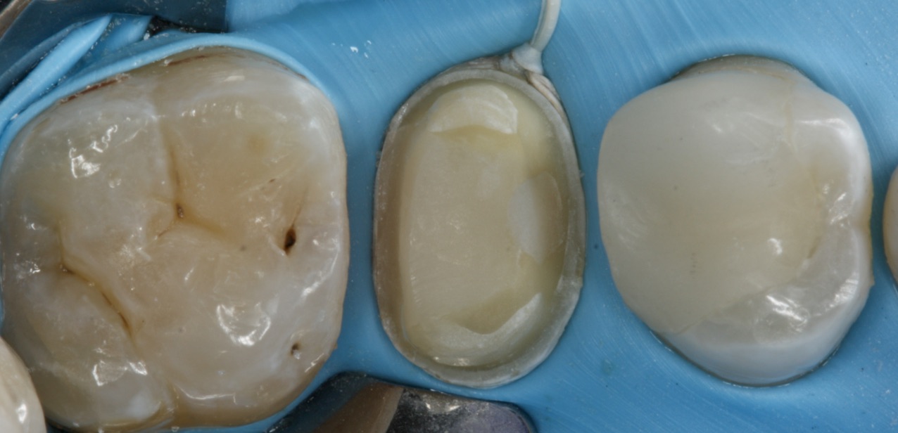 Rubber Dam The gold standard of Isolation 3D Dentists