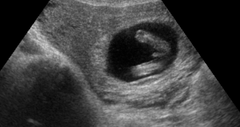 Early Gender Boys 13 Weeks 3D 4D HD Ultrasound Virginia