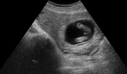 Early Gender Boys 13 Weeks 3D 4D HD Ultrasound Virginia