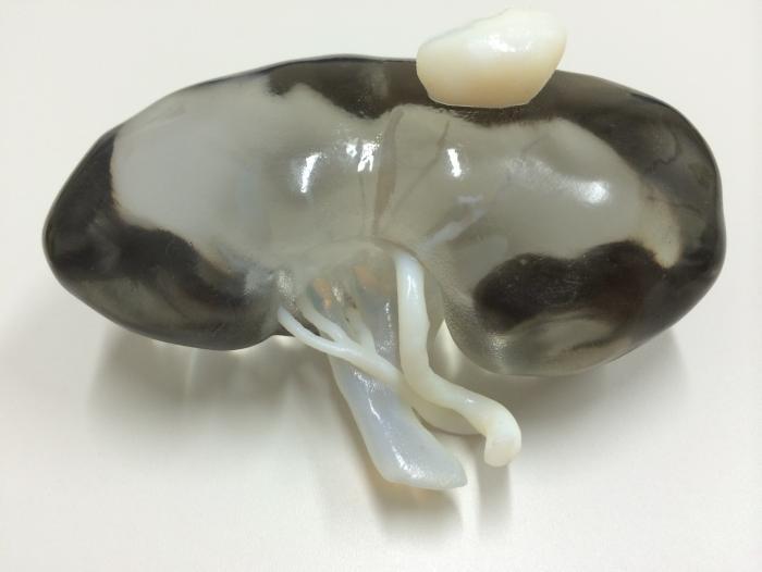 Surgeons Begin Using 3D Printing to Help Explain Patients’ Conditions
