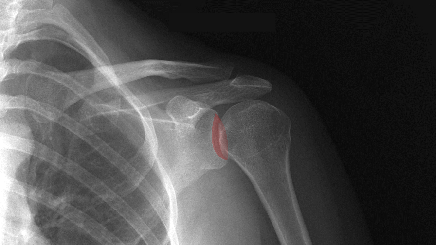 Patient to Receive First 3D Printed Shoulder Prosthesis in the