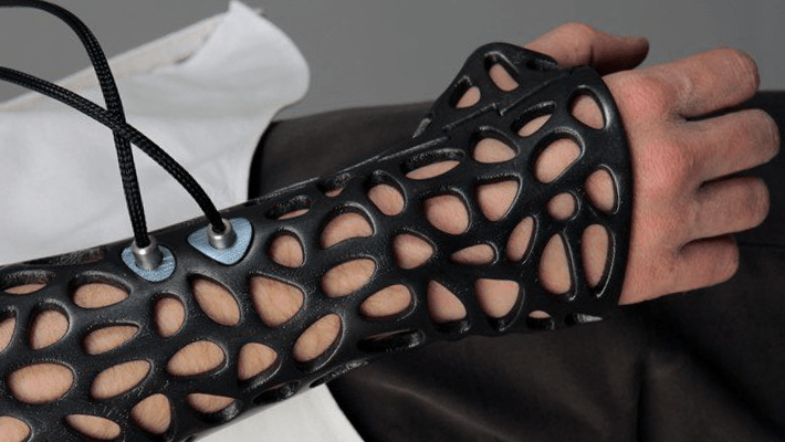 3D Printed Casts and Customized 3D Printed Braces for scoliosis
