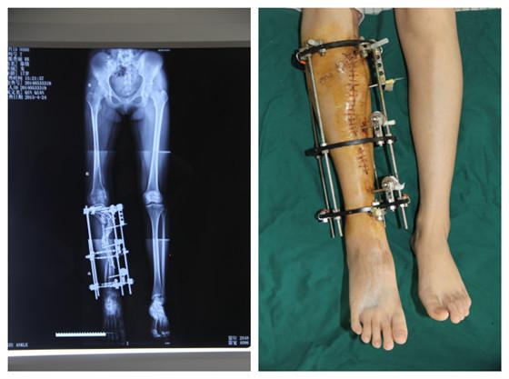 Surgeons 3D Print a Copy of a Woman’s Tibia to Straighten Her Severely
