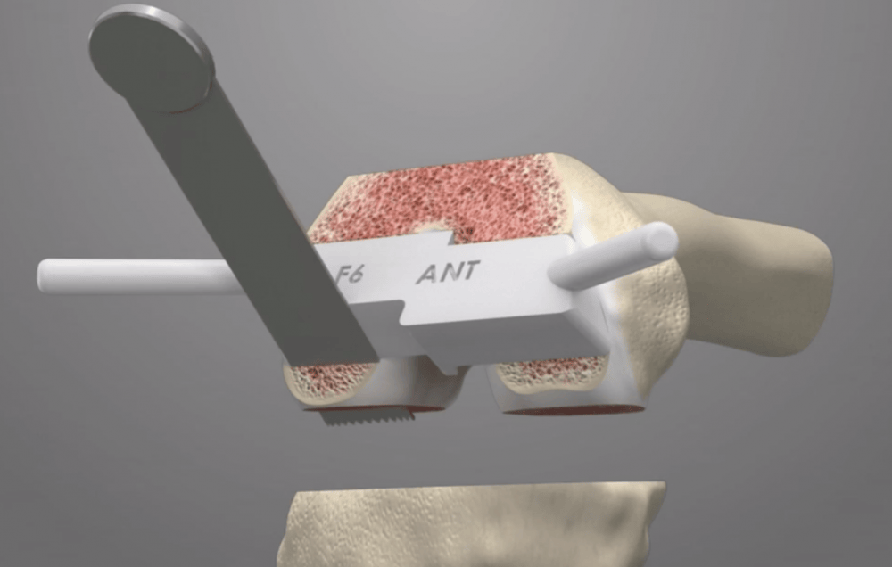 3D Printed Knee Replacement Manufacturer ConforMIS (CFMS) Raises 135M