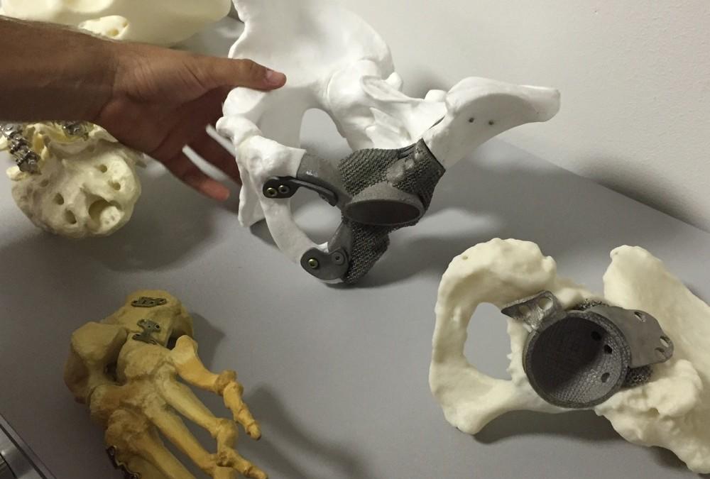 Italian Hospital Begins Using 3D Printed Prosthetic Bone Implants on