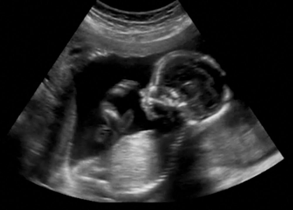 Nanyang Technological University Researchers Improve Ultrasound
