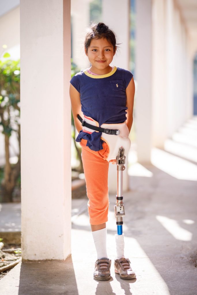 3D Printed Prosthetics The Prosthetics and Orthotics Podcast on