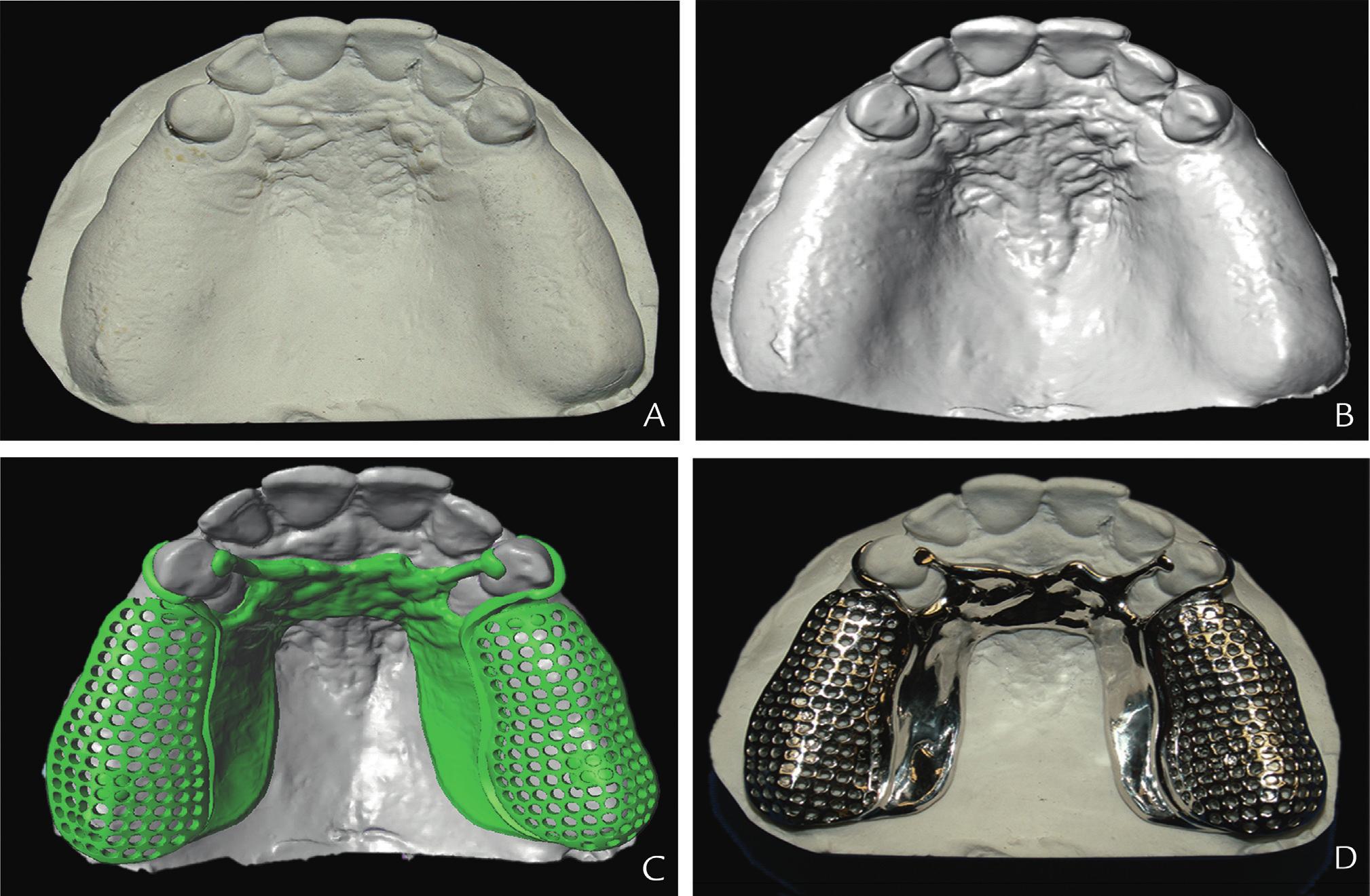 Clinical trial finds 3D printed dentures are preferred to conventional