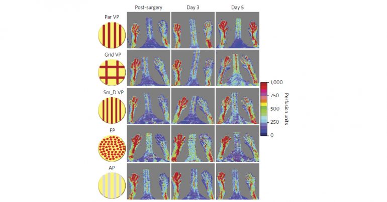 Vessel 3D printing could help treat world leading cause of disability