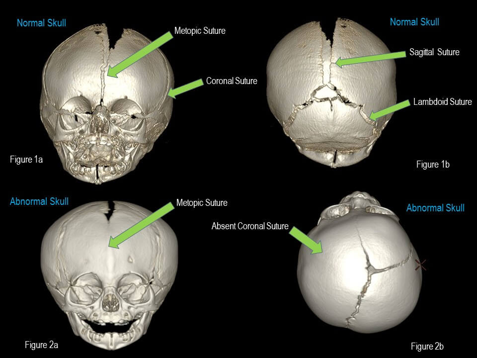 Craniosynostosis Causes, Symptoms, Diagnosis And Treatment, 52 OFF