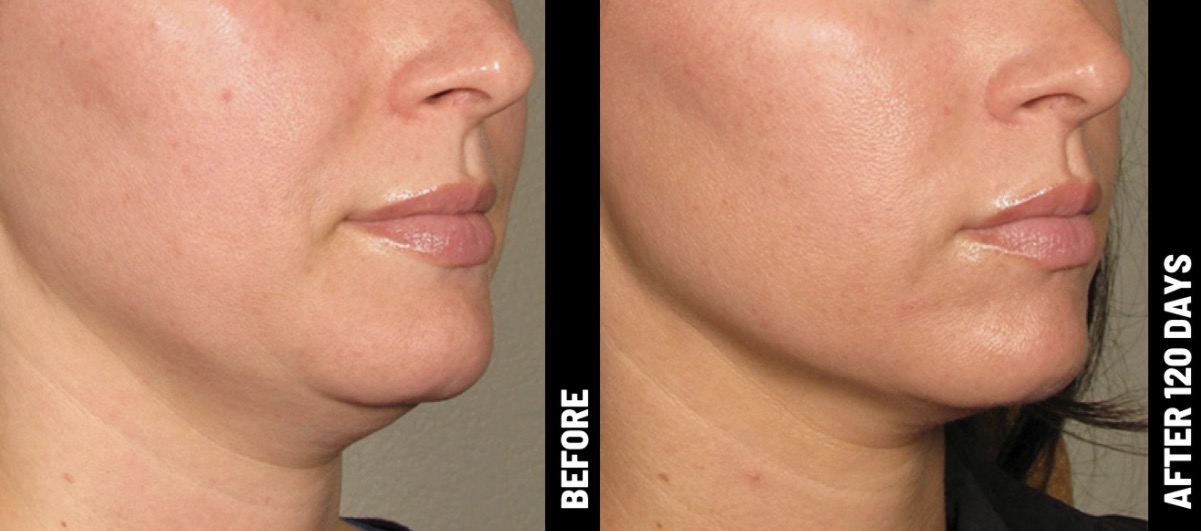 Ultherapy Noticeable Results With No Downtime 450 Derm