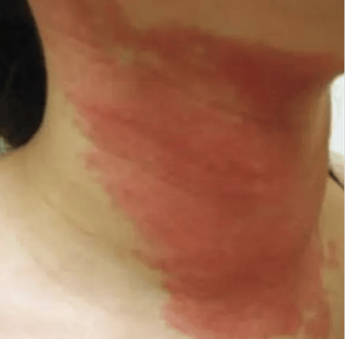 Fungal Infection Treatment Service In Part Ii,, Gurgaon, Estique Skin And Hair Clinic | Id: 21449988833