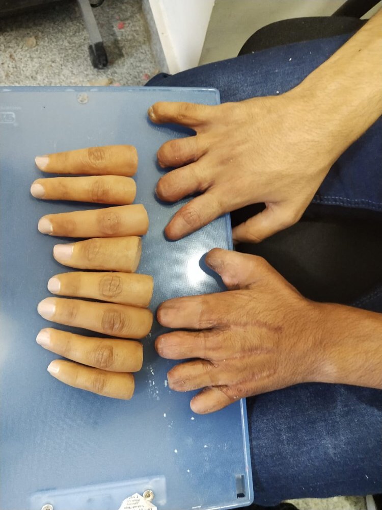 Silicone Artificial Silicon Fingers, Rs 16500 /piece Anand Corporate