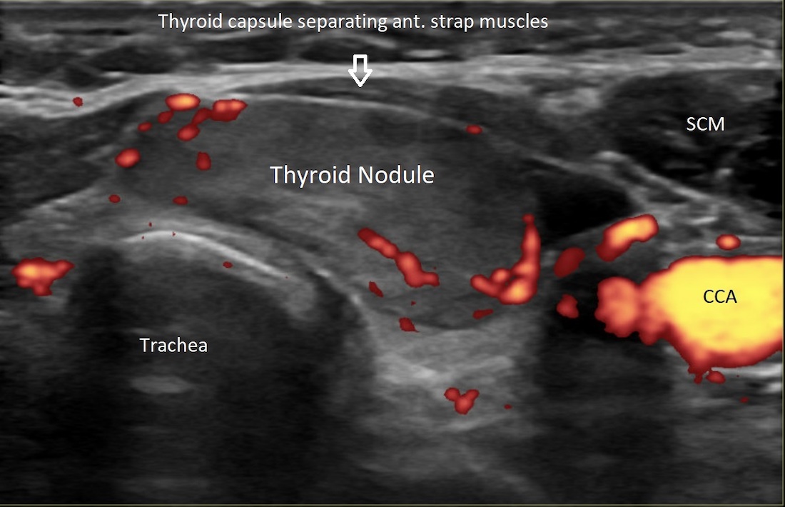 Radiofrequency Ablation Offers a Nonsurgical Treatment for Thyroid