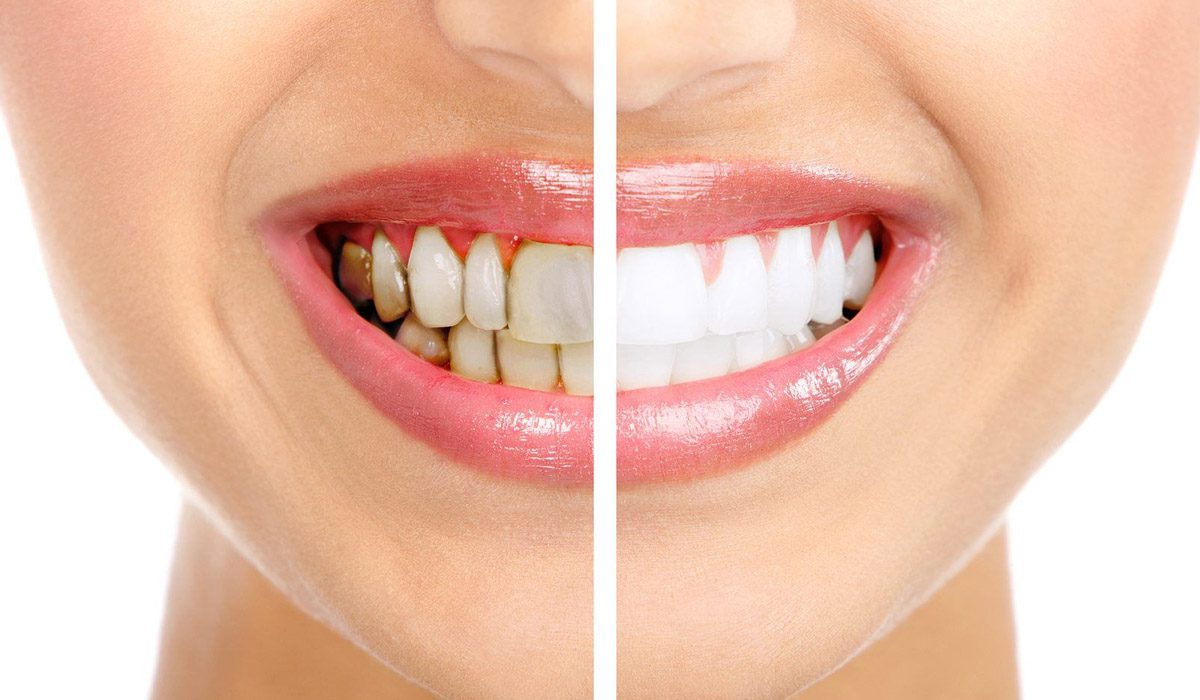 Things You Should Consider Before Getting Your Teeth Whitened 7
