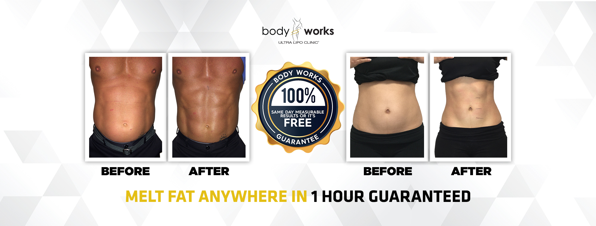 Bodyworks Ultra Lipo Clinic The New Alternative To Liposuction