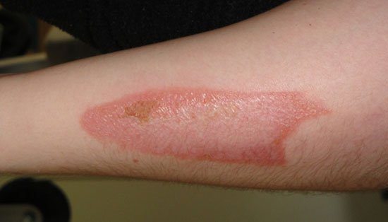 QUEIMADURA DE MOTO COMO CUIDAR POMADAS E OUTRO