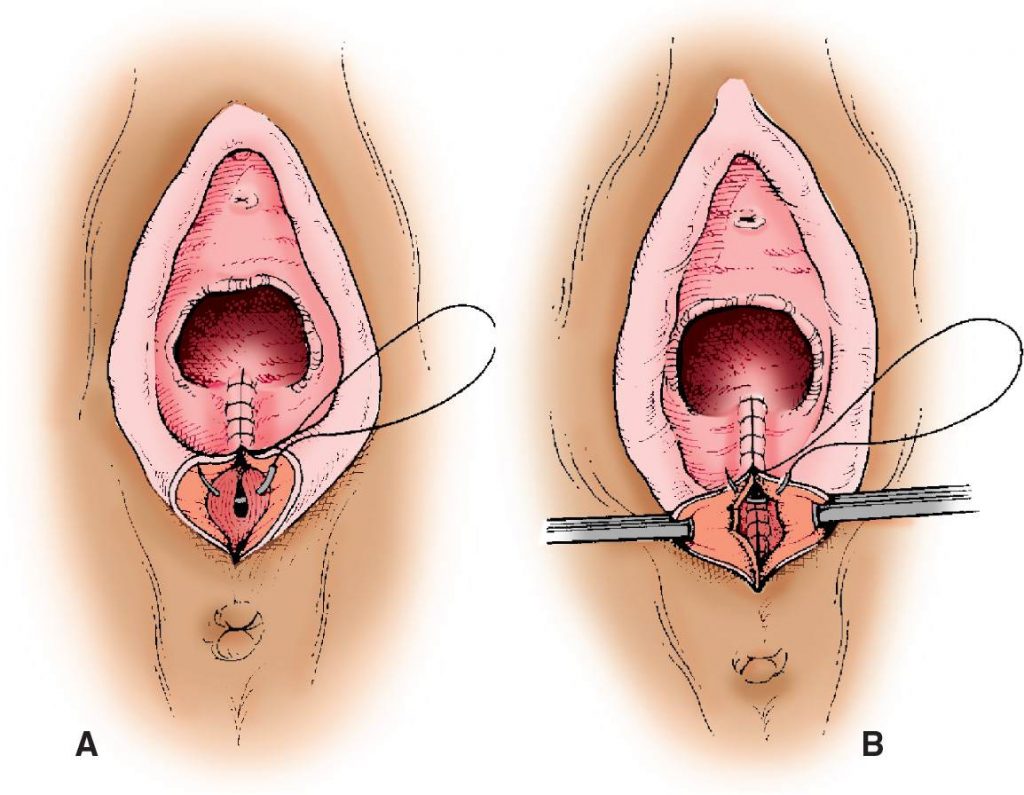 Cara Bersalin Normal Tanpa Jahitan / Cara Lawas Buang Air Besar Tanpa