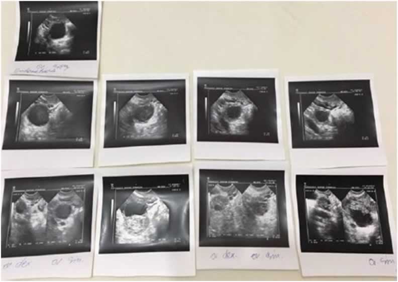 Acupuncture therapy for Infertility, weight loss, Knee and Back Pain